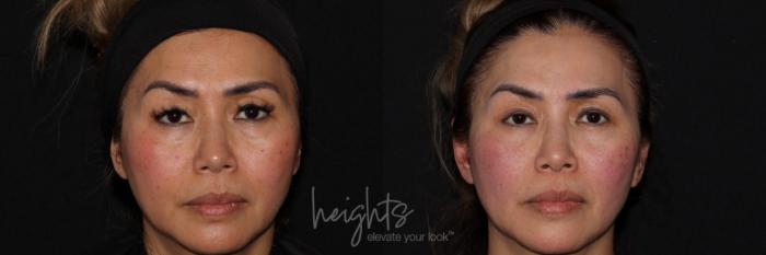 Before & After Eyelid Surgery Case 159 Front View in Burnaby & Vancouver, BC