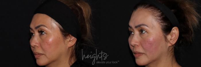 Before & After Eyelid Surgery Case 159 Left Oblique View in Burnaby & Vancouver, BC