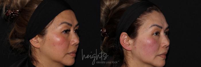 Before & After Eyelid Surgery Case 159 Right Oblique View in Burnaby & Vancouver, BC