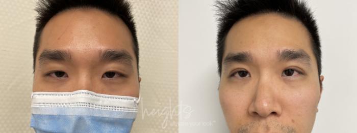 Before & After Eyelid Surgery Case 93 Front View in Vancouver (Burnaby), BC