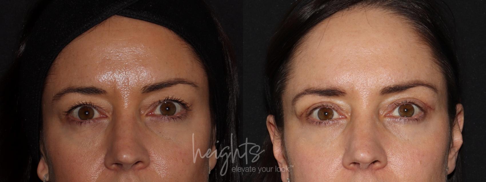 Before & After Eyelid Surgery Case 94 Front View in Vancouver (Burnaby), BC