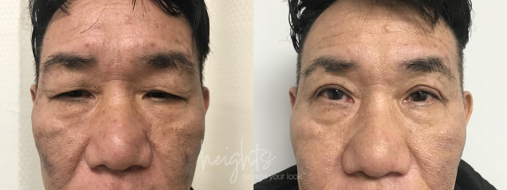 Before & After Eyelid Surgery Case 95 Front View in Vancouver (Burnaby), BC