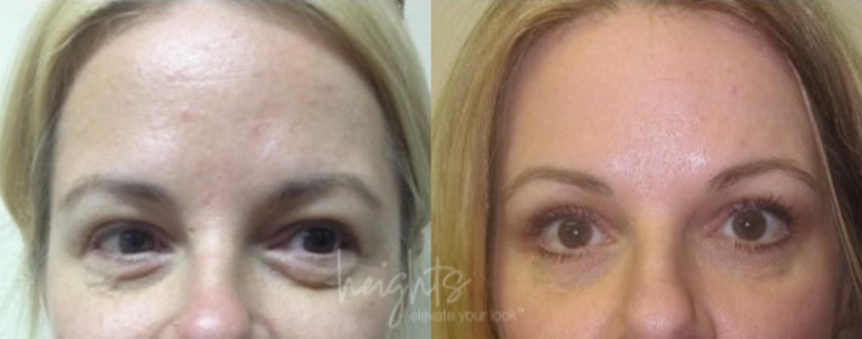 Before & After Eyelid Surgery Case 96 Front View in Vancouver (Burnaby), BC