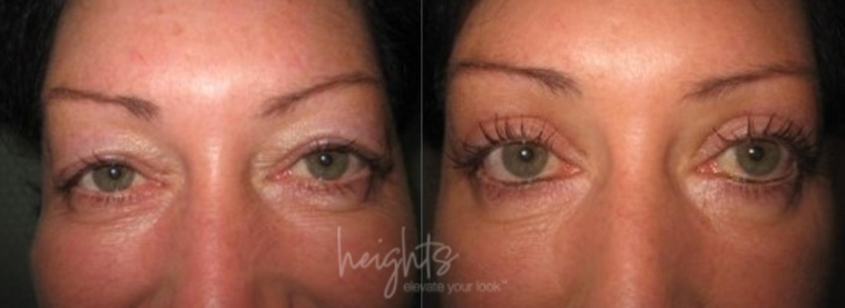 Before & After Eyelid Surgery Case 97 Front View in Vancouver (Burnaby), BC