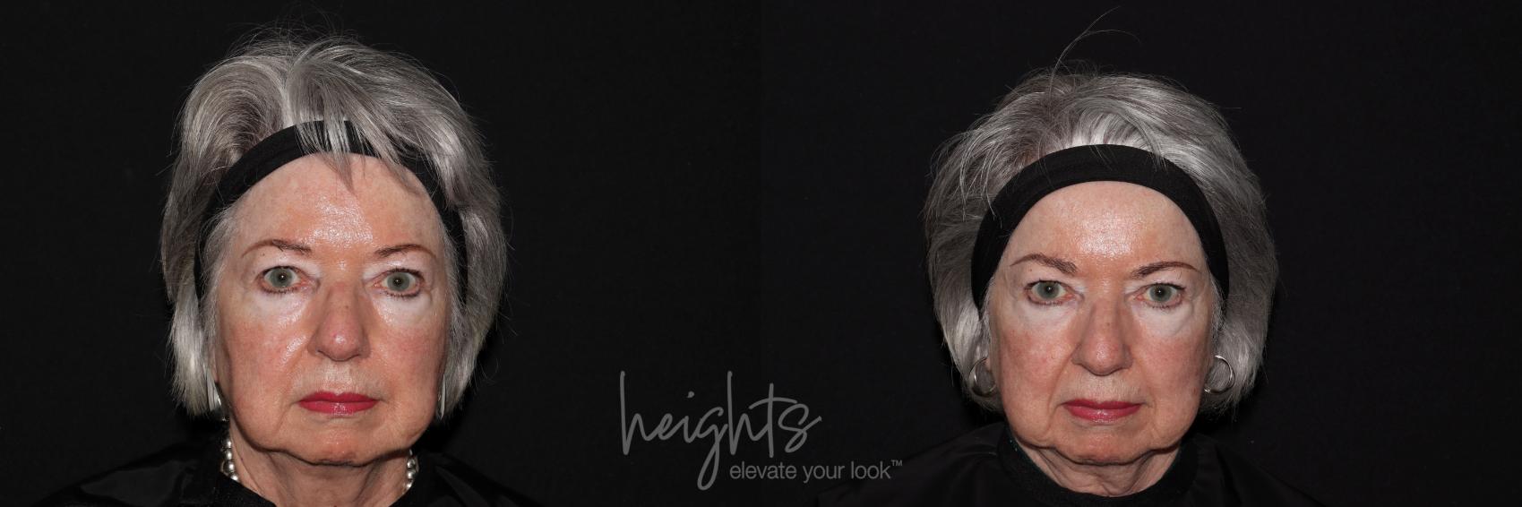 Before & After Glacial® fx Case 135 Front View in Vancouver (Burnaby), BC