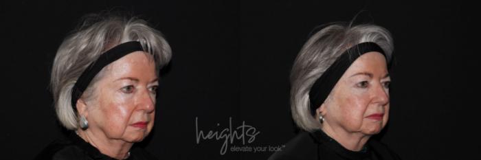 Before & After Glacial® fx Case 135 Left Oblique View in Vancouver (Burnaby), BC
