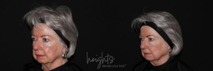 Before & After Glacial® fx Case 135 Right Oblique View in Vancouver (Burnaby), BC