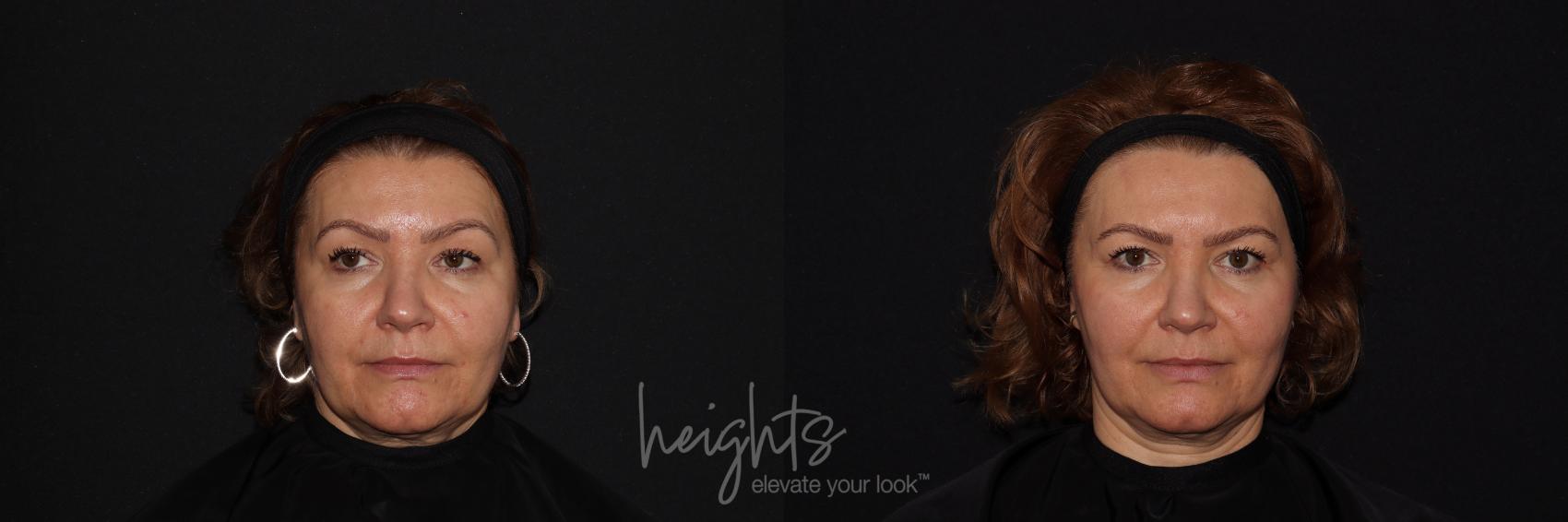 Before & After IPL Photofacial Case 120 Front View in Vancouver (Burnaby), BC
