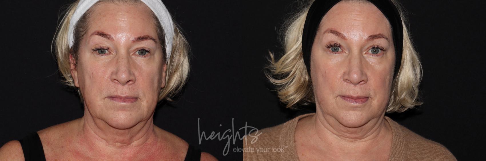 Before & After IPL Photofacial Case 148 Front View in Burnaby & Vancouver, BC