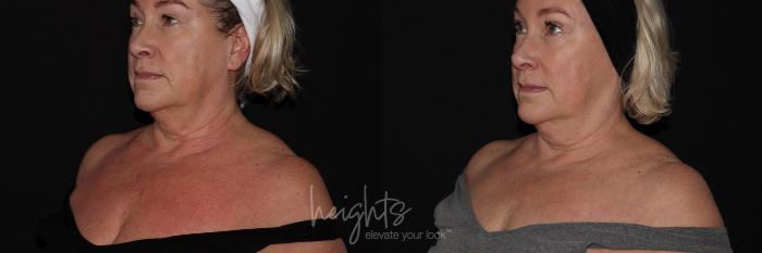 Before & After IPL Photofacial Case 148 left oblique declotte View in Burnaby & Vancouver, BC
