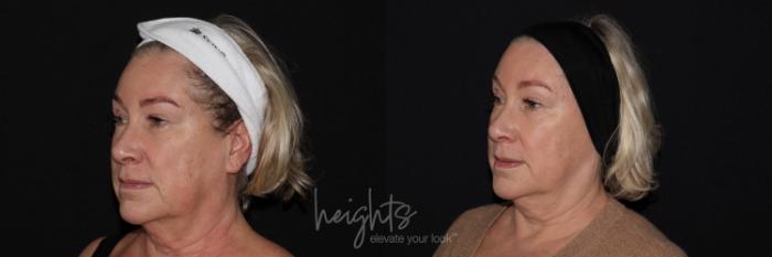 Before & After IPL Photofacial Case 148 Left Oblique View in Burnaby & Vancouver, BC