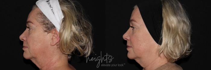 Before & After IPL Photofacial Case 148 Left Side View in Burnaby & Vancouver, BC
