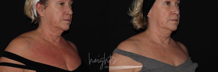 Before & After IPL Photofacial Case 148 right oblique declotte View in Burnaby & Vancouver, BC
