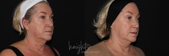 Before & After IPL Photofacial Case 148 Right Oblique View in Burnaby & Vancouver, BC
