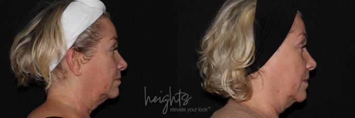 Before & After IPL Photofacial Case 148 Right Side View in Burnaby & Vancouver, BC