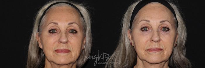 Before & After IPL Photofacial Case 150 Front View in Burnaby & Vancouver, BC