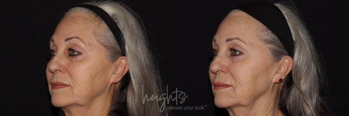 Before & After IPL Photofacial Case 150 Left Oblique View in Burnaby & Vancouver, BC