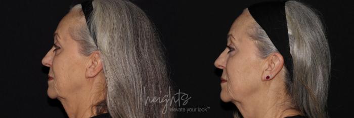 Before & After IPL Photofacial Case 150 Left Side View in Burnaby & Vancouver, BC