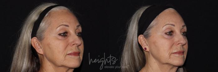 Before & After IPL Photofacial Case 150 Right Oblique View in Burnaby & Vancouver, BC