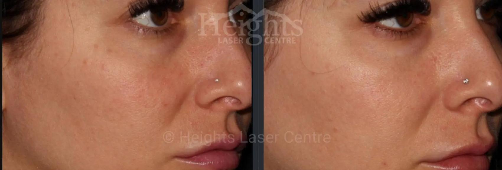 Before & After IPL Photofacial Case 3 Right Side View in Vancouver (Burnaby), BC