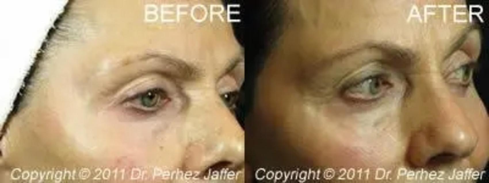 Before & After IPL Photofacial Case 4 Right Side View in Vancouver (Burnaby), BC