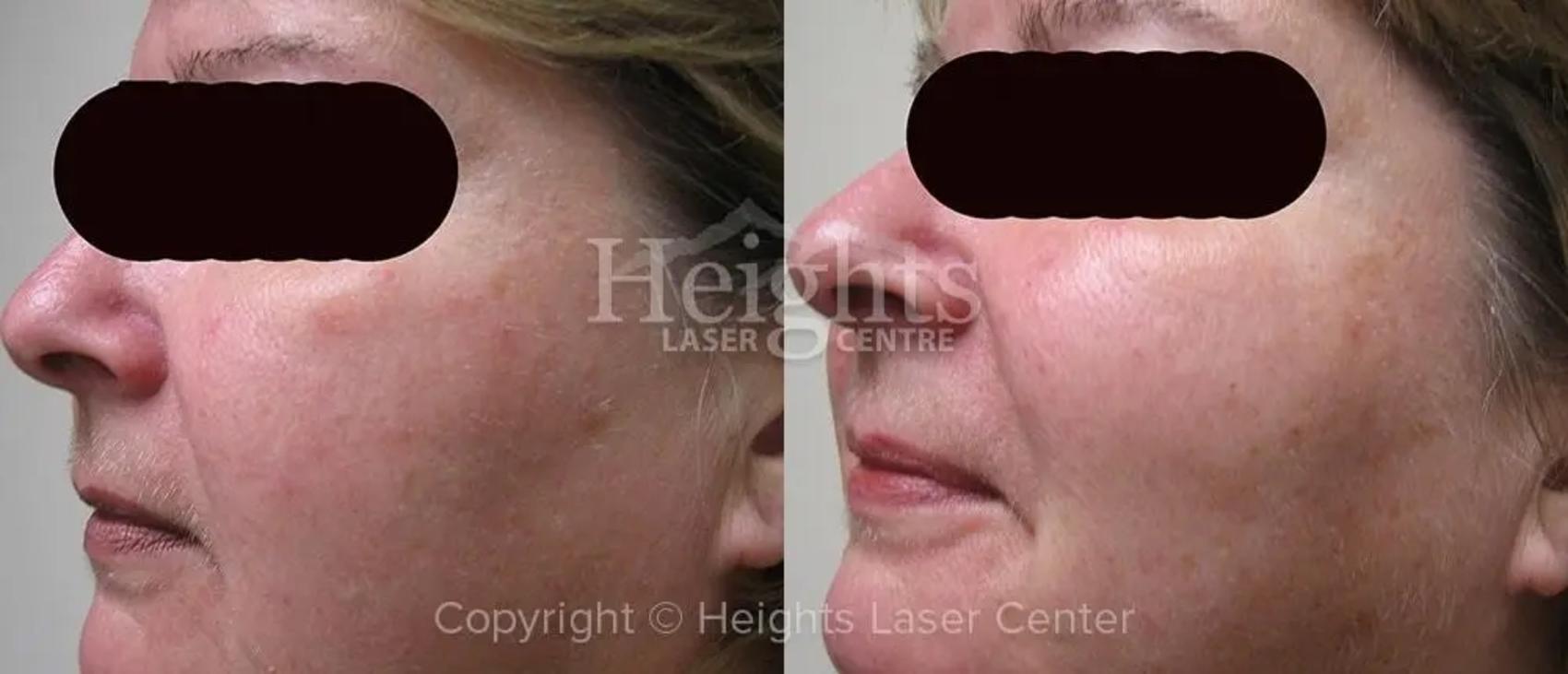 Before & After IPL Photofacial Case 5 Left Side View in Vancouver (Burnaby), BC