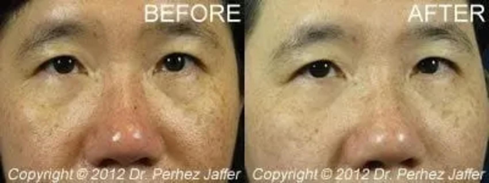 Before & After IPL Photofacial Case 6 Front View in Vancouver (Burnaby), BC
