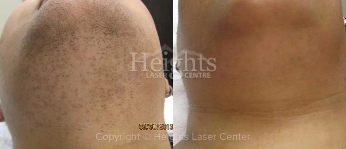 Before & After Laser Hair Removal Case 2 Front View in Vancouver (Burnaby), BC