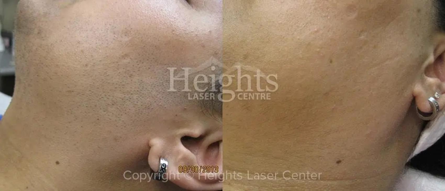 Before & After Laser Hair Removal Case 2 Left Side View in Vancouver (Burnaby), BC
