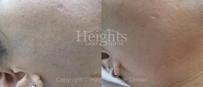 Before & After Laser Hair Removal Case 2 Right Side View in Vancouver (Burnaby), BC