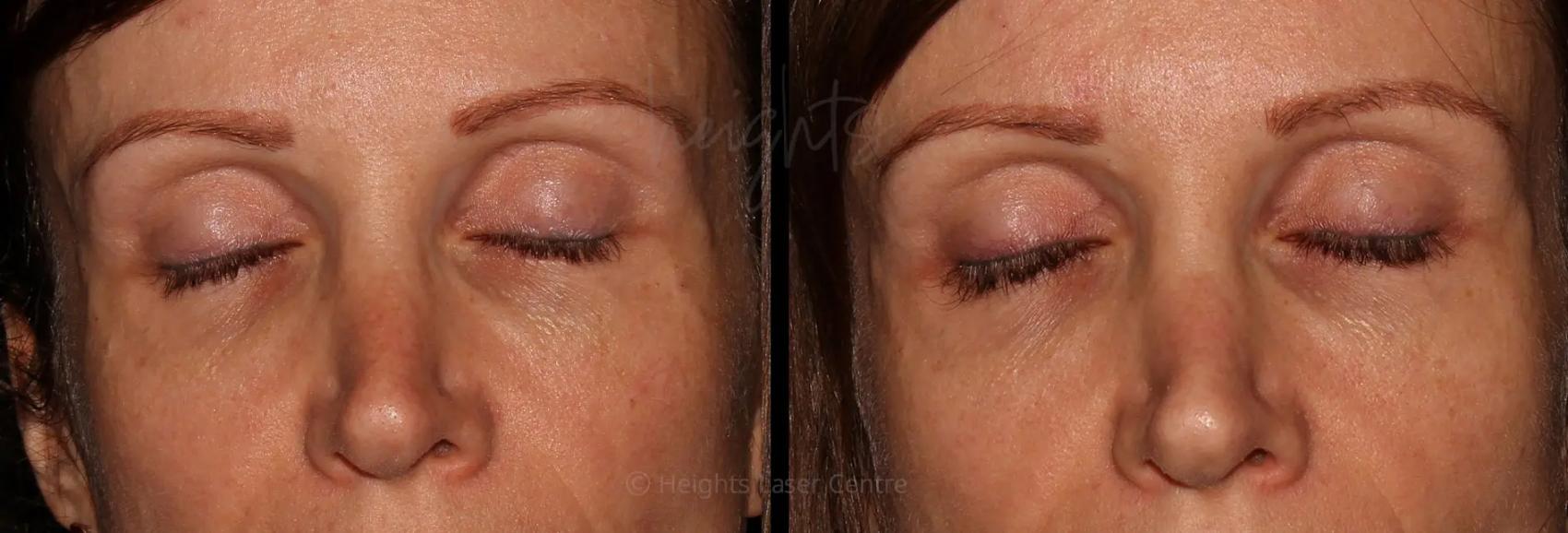 Before & After LATISSE® Case 1 Close Up View in Vancouver (Burnaby), BC