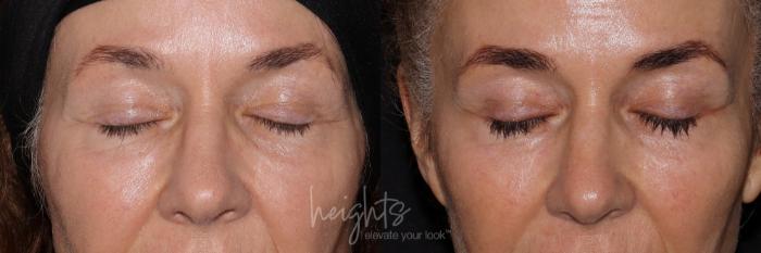 Before & After LATISSE® Case 158 Front View in Burnaby & Vancouver, BC