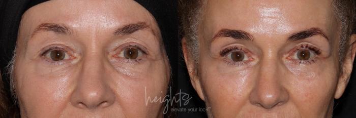 Before & After LATISSE® Case 158 Frontal eyes open View in Burnaby & Vancouver, BC