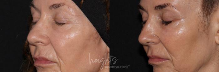 Before & After LATISSE® Case 158 Left Oblique View in Burnaby & Vancouver, BC