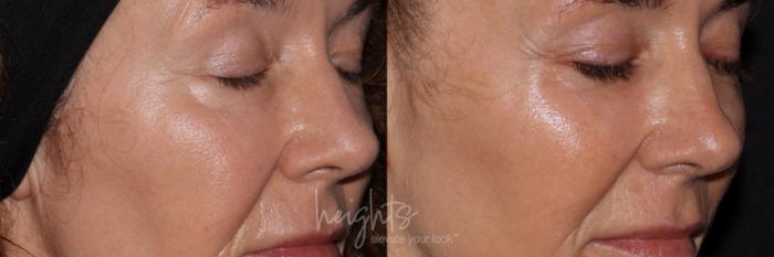 Before & After LATISSE® Case 158 Right oblique eyes closed View in Burnaby & Vancouver, BC