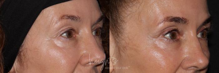 Before & After LATISSE® Case 158 Right Oblique View in Burnaby & Vancouver, BC