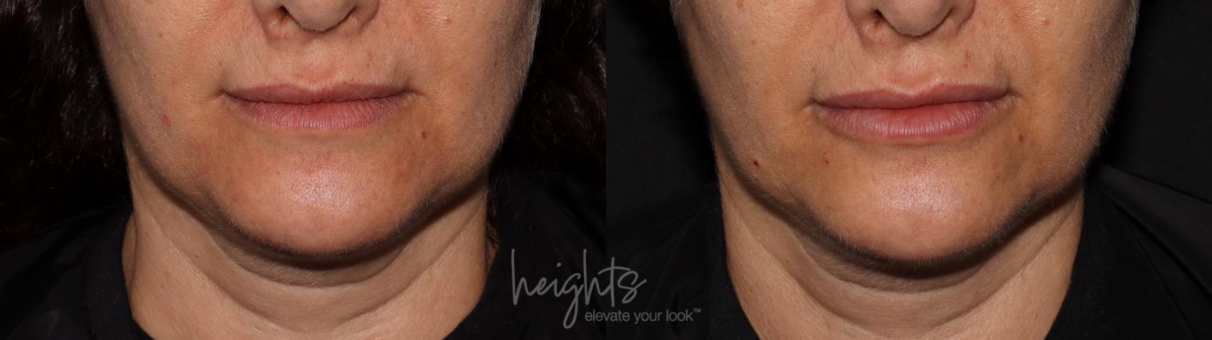 Before & After Lip Filler—Love Your Lips™ Case 100 Front View in Vancouver (Burnaby), BC