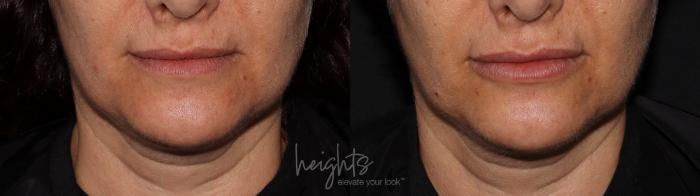 Before & After Lip Filler—Love Your Lips™ Case 100 Front View in Vancouver (Burnaby), BC
