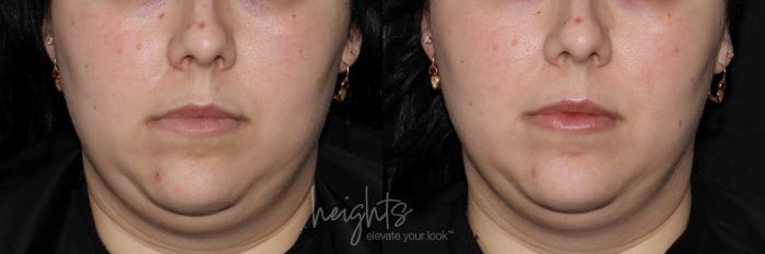 Before & After Lip Filler—Love Your Lips™ Case 129 Front View in Vancouver (Burnaby), BC