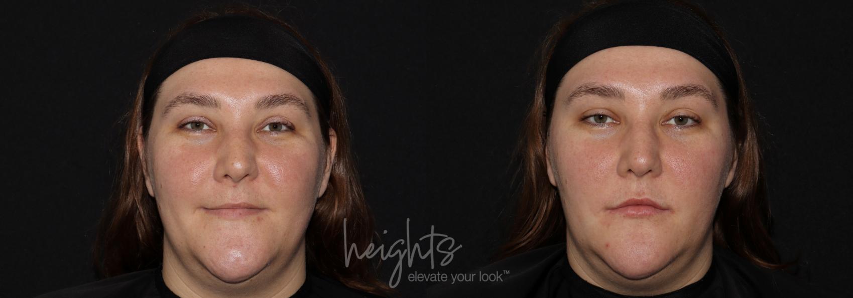 Before & After Lip Filler—Love Your Lips™ Case 147 Front View in Vancouver (Burnaby), BC