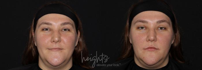 Before & After Lip Filler—Love Your Lips™ Case 147 Front View in Vancouver (Burnaby), BC