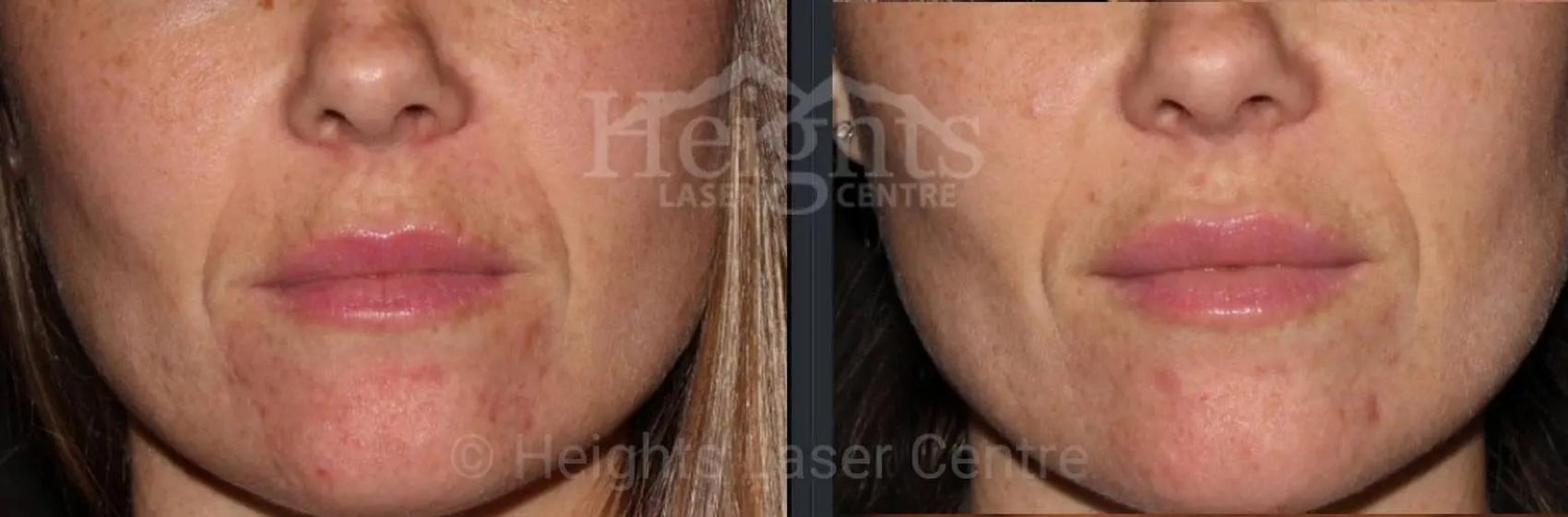 Before & After Lip Filler—Love Your Lips™ Case 33 Front View in Vancouver (Burnaby), BC