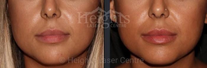 Before & After Lip Filler—Love Your Lips™ Case 34 Front View in Vancouver (Burnaby), BC