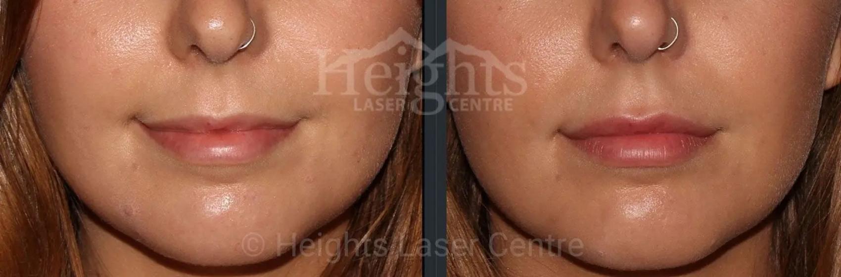 Before & After Lip Filler—Love Your Lips™ Case 35 Front View in Vancouver (Burnaby), BC