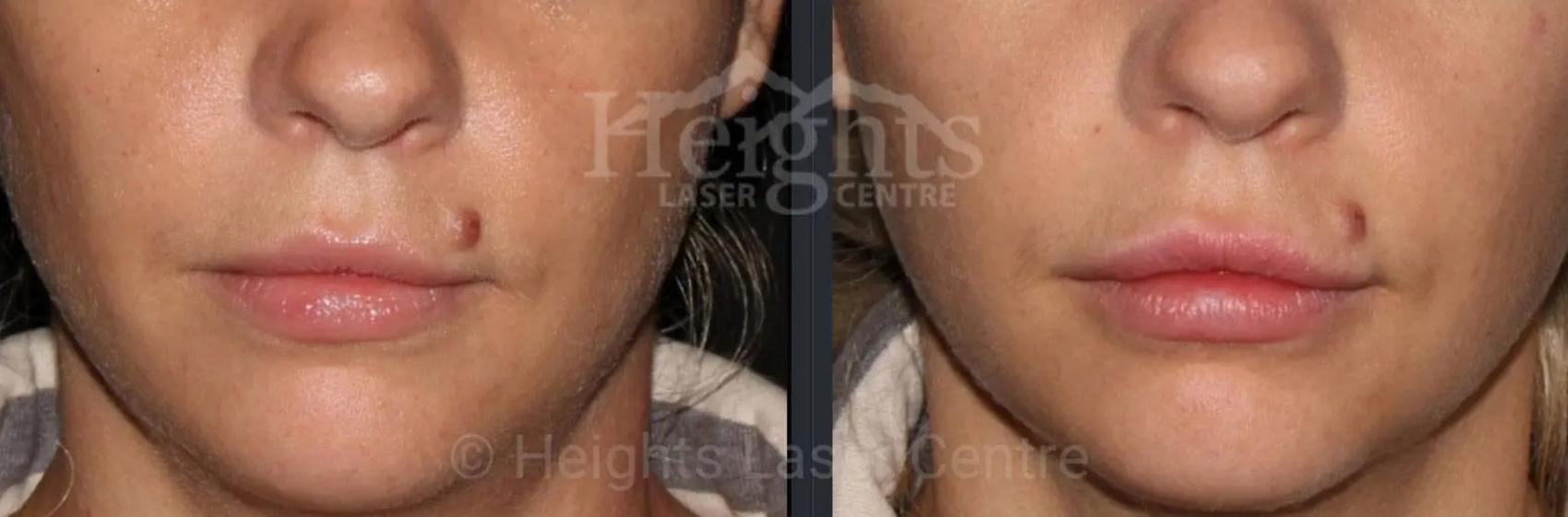 Before & After Lip Filler—Love Your Lips™ Case 36 Front View in Vancouver (Burnaby), BC