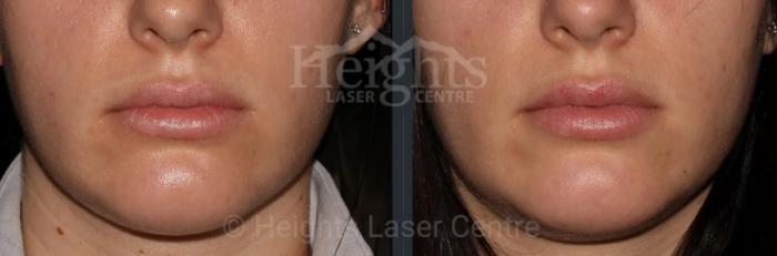 Before & After Lip Filler—Love Your Lips™ Case 37 Front View in Vancouver (Burnaby), BC