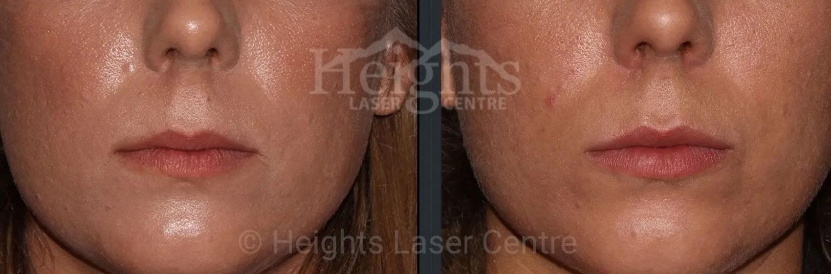 Before & After Lip Filler—Love Your Lips™ Case 38 Front View in Vancouver (Burnaby), BC