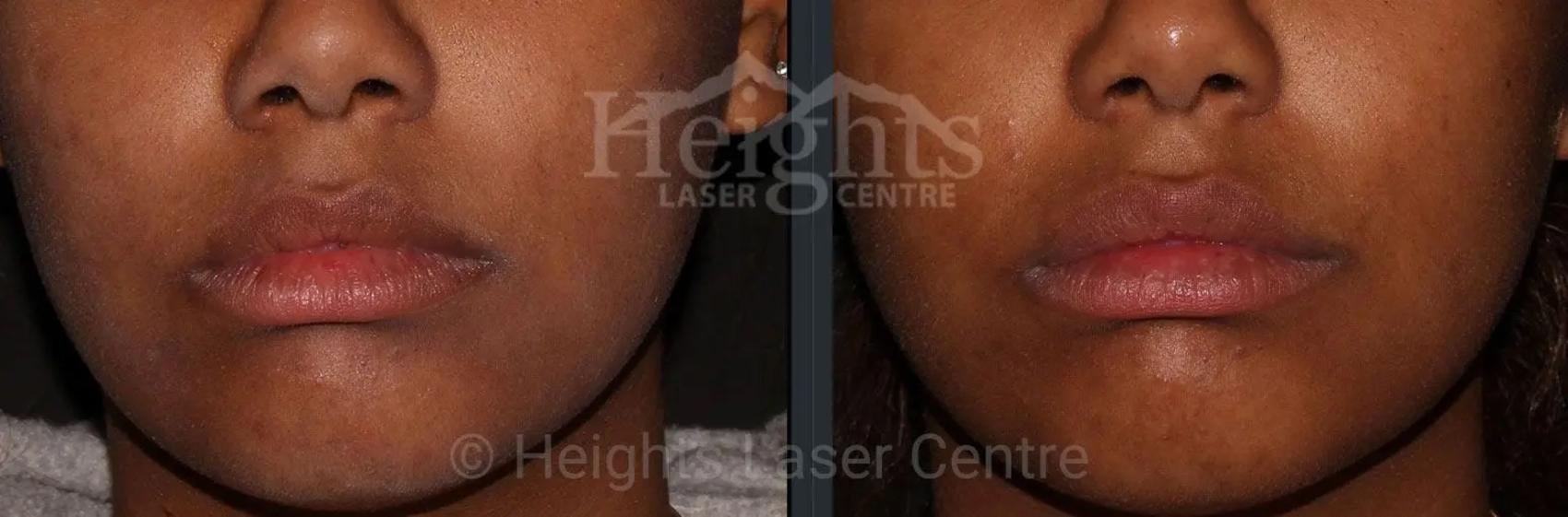 Before & After Lip Filler—Love Your Lips™ Case 39 Front View in Vancouver (Burnaby), BC