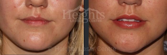 Before & After Lip Filler—Love Your Lips™ Case 41 Front View in Vancouver (Burnaby), BC