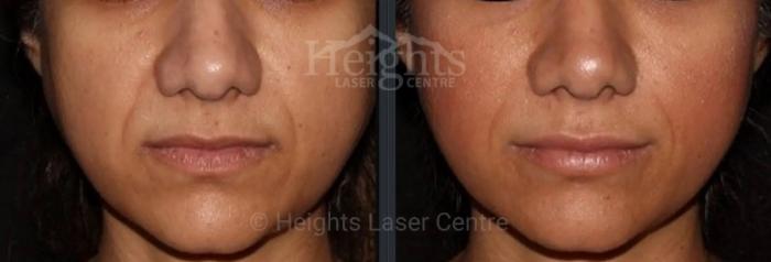 Before & After Dermal Fillers Case 43 Front View in Vancouver (Burnaby), BC